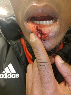 Photo : Ex-Flying Eagle Gero Suffers Nasty Injury In Europa League (Viewers Discretion)